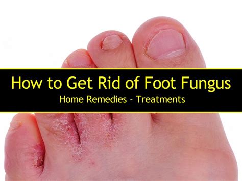 How to Get Rid of Foot Fungus Fast With Home Remedies