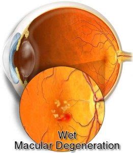 Dry & Wet AMD - Signs, Symptoms, and Diagnosis - Cure AMD Foundation