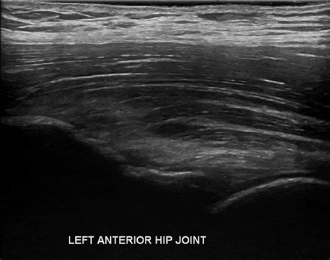 Hip Ultrasound Diagnostic Imaging - Melbourne Radiology