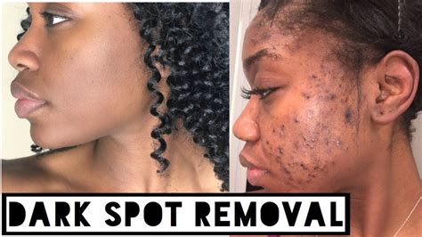 Acne Scars And Dark Spots Treatment - shearlingwomenbestquality