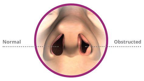 VivAer® Treatment For Nasal Obstruction New York NY