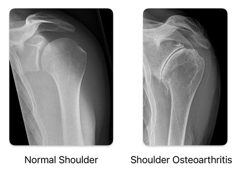 Shoulder Arthritis Treatment in Raleigh | Raleigh Hand to Shoulder Center