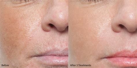 Microneedling Before and After Gallery - MD Needle PenMD Needle Pen