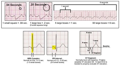 How To Interpret An Electrocardiogram Ecg | Images and Photos finder