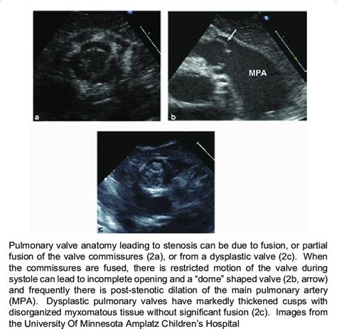 Echocardiography images of stenotic pulmonary valves. | Download Scientific Diagram