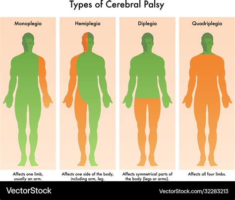 Types cerebral palsy Royalty Free Vector Image