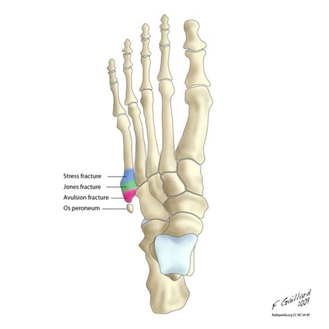 Fifth metatarsal fracture - WikEM