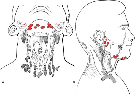 Parotid Cancer Lymph Nodes