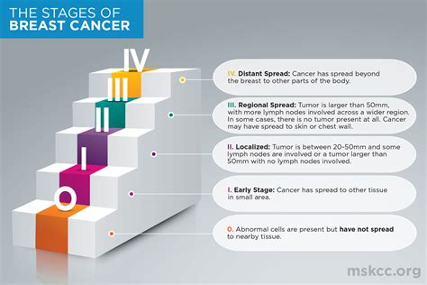 Breast Cancer Stages 0, 1, 2, 3 and 4 | Memorial Sloan Kettering Cancer Center