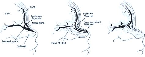 Foramen Cecum Embryology