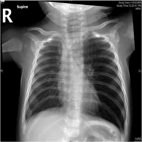 Chest X-ray, AP view: Marked hyperinflation, diaphragm at the 11 th rib... | Download Scientific ...