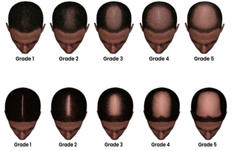 Figure 10. [Modified Sinclair Scale for female...]. - Endotext - NCBI Bookshelf