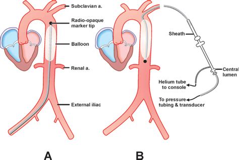 Intra-Aortic Balloon Pump (IABP) Placement | Thoracic Key