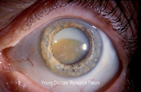 Images For Cataract ~ YOUNG DOCTORS' RESEARCH FORUM