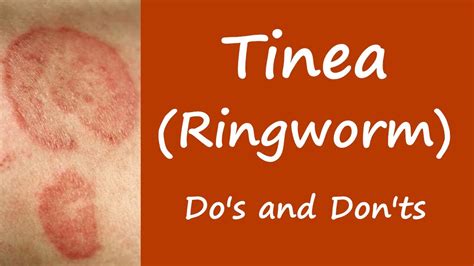 Ringworm: Symptoms, Causes Treatment, 52% OFF