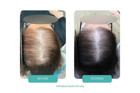 Dual Treatment for Androgenic Alopecia in Boston, MA