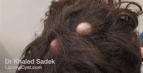 scalp cyst removal Archives - LipomaCyst.com | Cyst and Lipoma Specialists