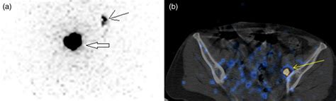 Predictive value of sentinel lymph node imaging and biopsy i... : Nuclear Medicine Communications