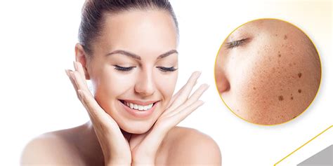 Face Skin Pigmentation Treatment in Mumbai, India