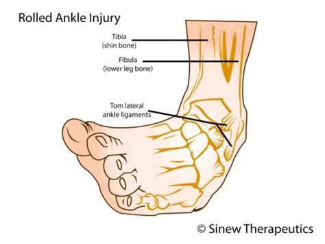 Sprained Ankle Information - Sinew Therapeutics