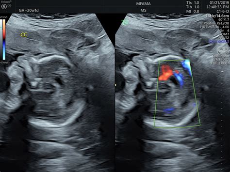 Anatomy Ultrasound | Maternal Fetal Associates of the Mid-Atlantic