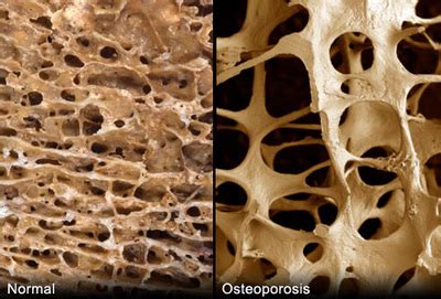 Diseases of the Skeletal System - The Skeletal System and its Diseases