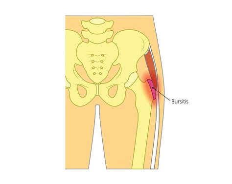 Greater Trochanter Bursitis Symptoms