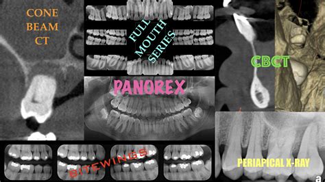 Periapical X Ray Techniques : Types Of Dental Radiographs And Their ...