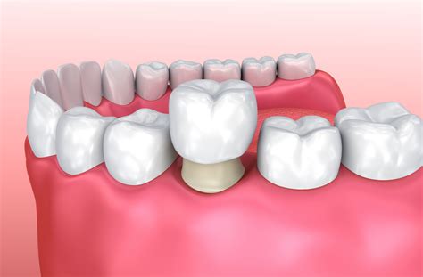 Dental Crown Types: Which Material is Best for You?