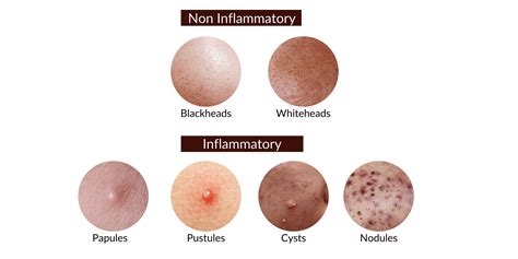 Acne Treatments For Different Types of Blemishes | Ensoul Medical Clinic