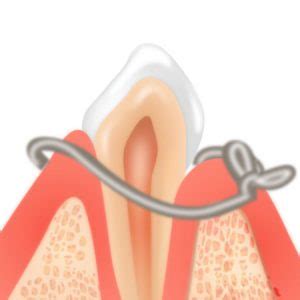 Pocket Reduction Surgery | Baldan Periodontics