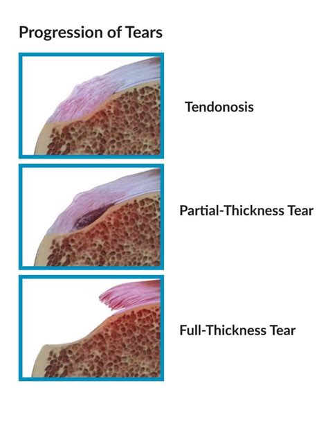 What is Rotator Cuff Tendinosis? – Howard J. Luks, MD