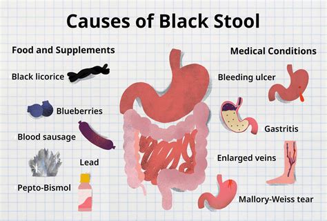 Why Is My Poop Black? Causes Of Tarry Stool, 52% OFF