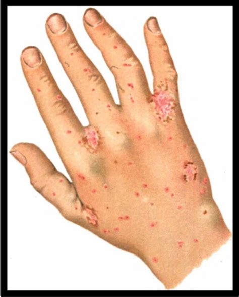 8 best Home Remedies For Scabies - How To Get Scabies, Sulfur Soap Scabies images on Pinterest ...