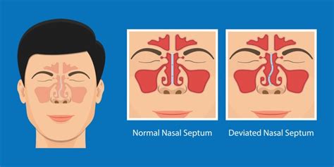 Deviated Septum - Ohio Head and Neck Surgeons