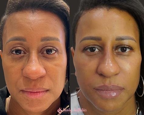 Cheek Fillers - Before & After Results at Skinly