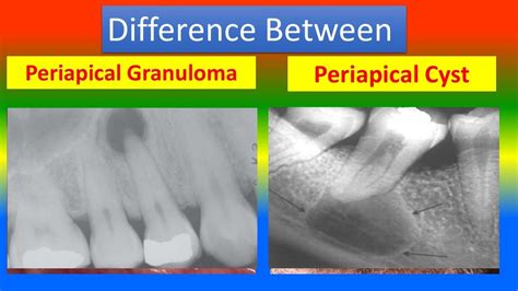 Periapical Granuloma Radiograph