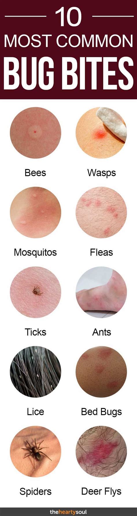 10 Bug Bites Anyone Should Be Able to Identify