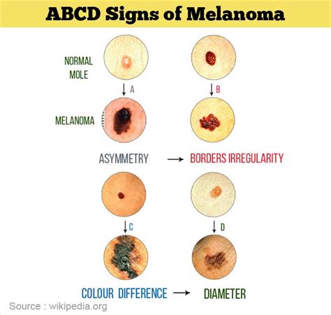 Malignant Melanoma Symptoms And Signs: Understanding the Warning Signals - Doctor Heck