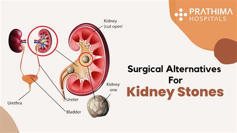 Treatment for Kidney Stones - Best Urologist in Hyderabad