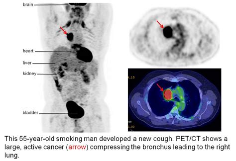 How Does Cancer Appear On A Pet Scan - PetsWall