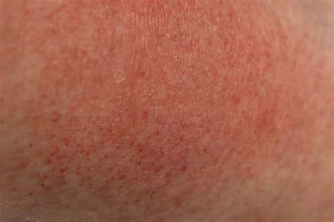 Heat rash, sun rash -- what's the difference? | OSF HealthCare