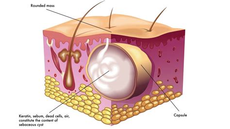 Sebaceous Cyst Removal - Excision Gold Coast | Skin Clinic Robina