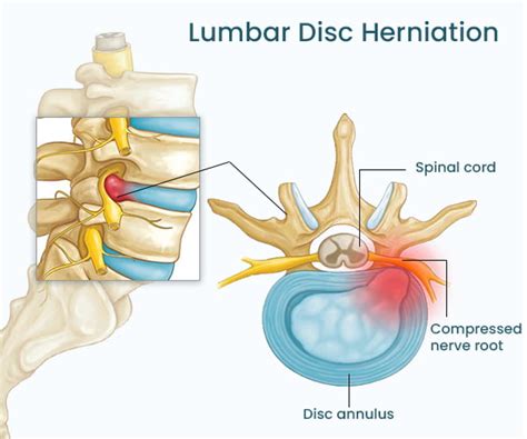 Spinal Disc Protrusion