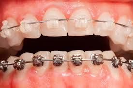 Clear vs Metal Braces - Best Orthodontist NYC