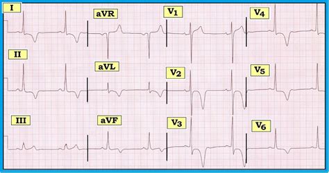 ECG Interpretation: ECG Blog #59 — Giant T - Ischemia -Yamaguchi