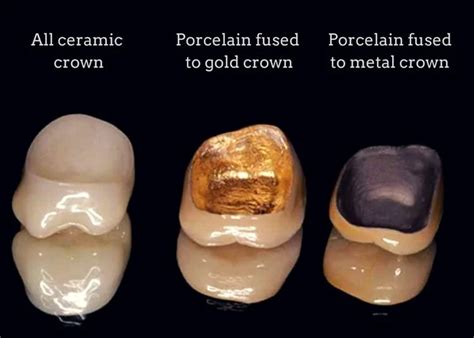 What is the Typical Cost of a Dental Crown?