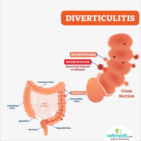 Diverticulitis – Causes, Symptoms and Treatment | Netmeds