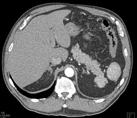 Multiple Accessory Spleens in Patient s/p Splenectomy - Spleen Case Studies - CTisus CT Scanning