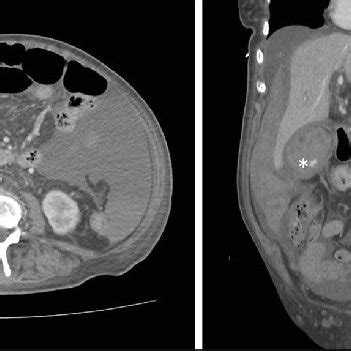 A. CT-scan image in which a hemoperitoneum and a gallbladder full of... | Download Scientific ...